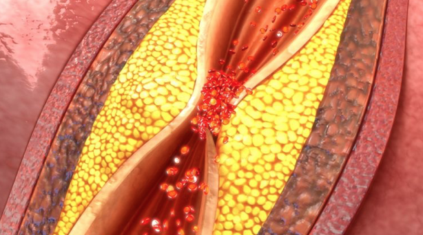 Cholesterol 4